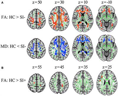 Associations Among Suicidal Ideation, White Matter Integrity and Cognitive Deficit in First-Episode Schizophrenia